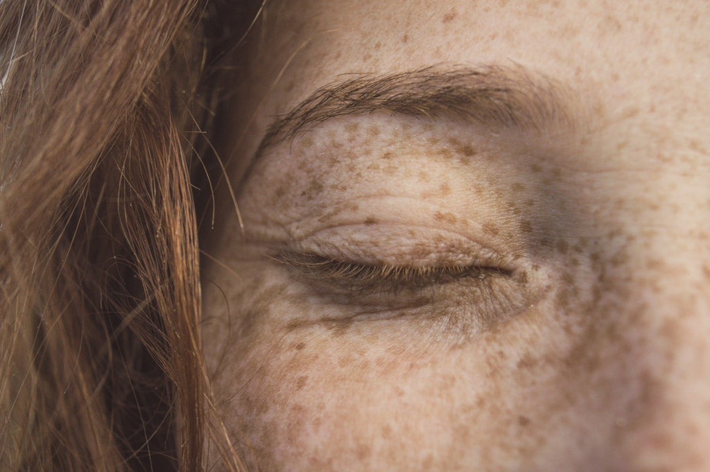 Are Freckles Sun Damage? What You Should Know