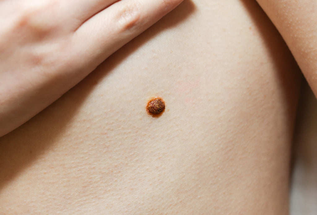 The Different Types of Skin Cancers, Explained