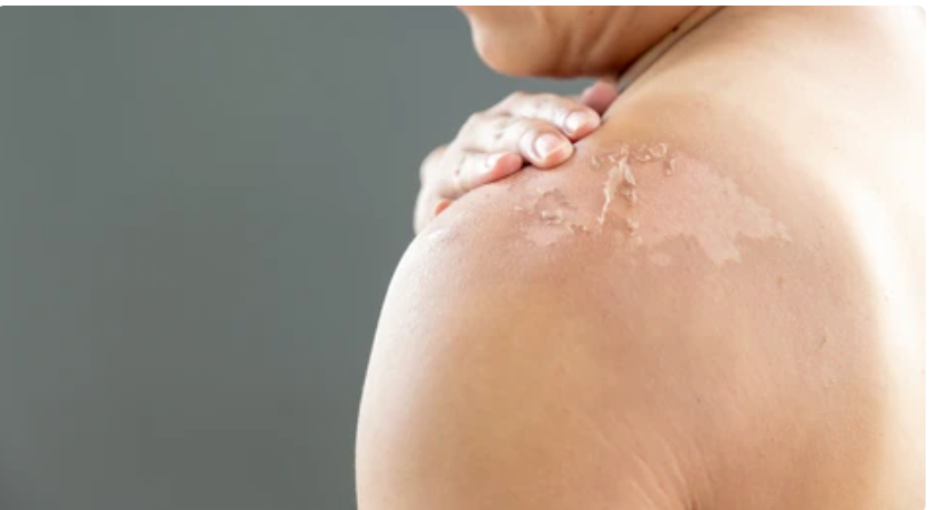 The Types of Skin Damage Caused by the Sun