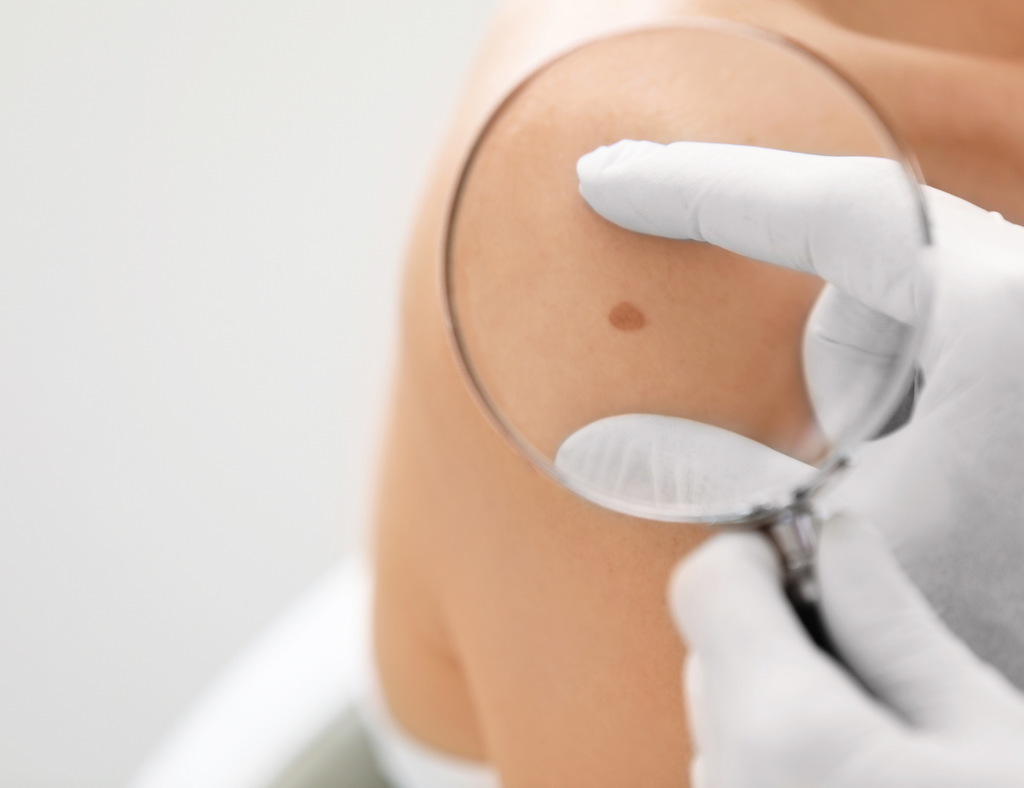 What to Expect During an Annual Skin Cancer Screening