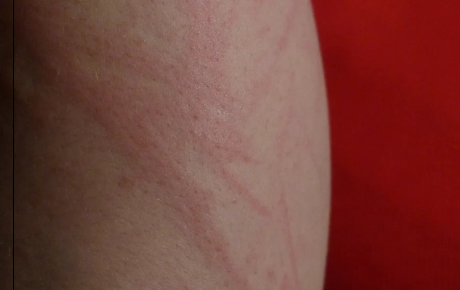 Sun Rash - What Is It and How UV Protective Clothing Can Help? – BloqUV