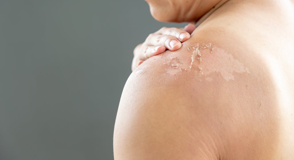 The Types of Skin Damage Caused by the Sun